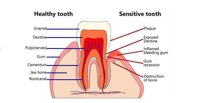 teeth-sensitive